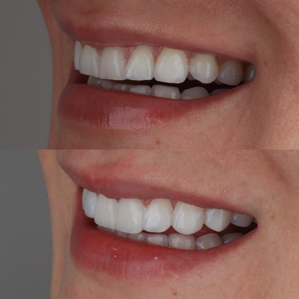 Antes e depois de facetas em resina com gengivoplastia