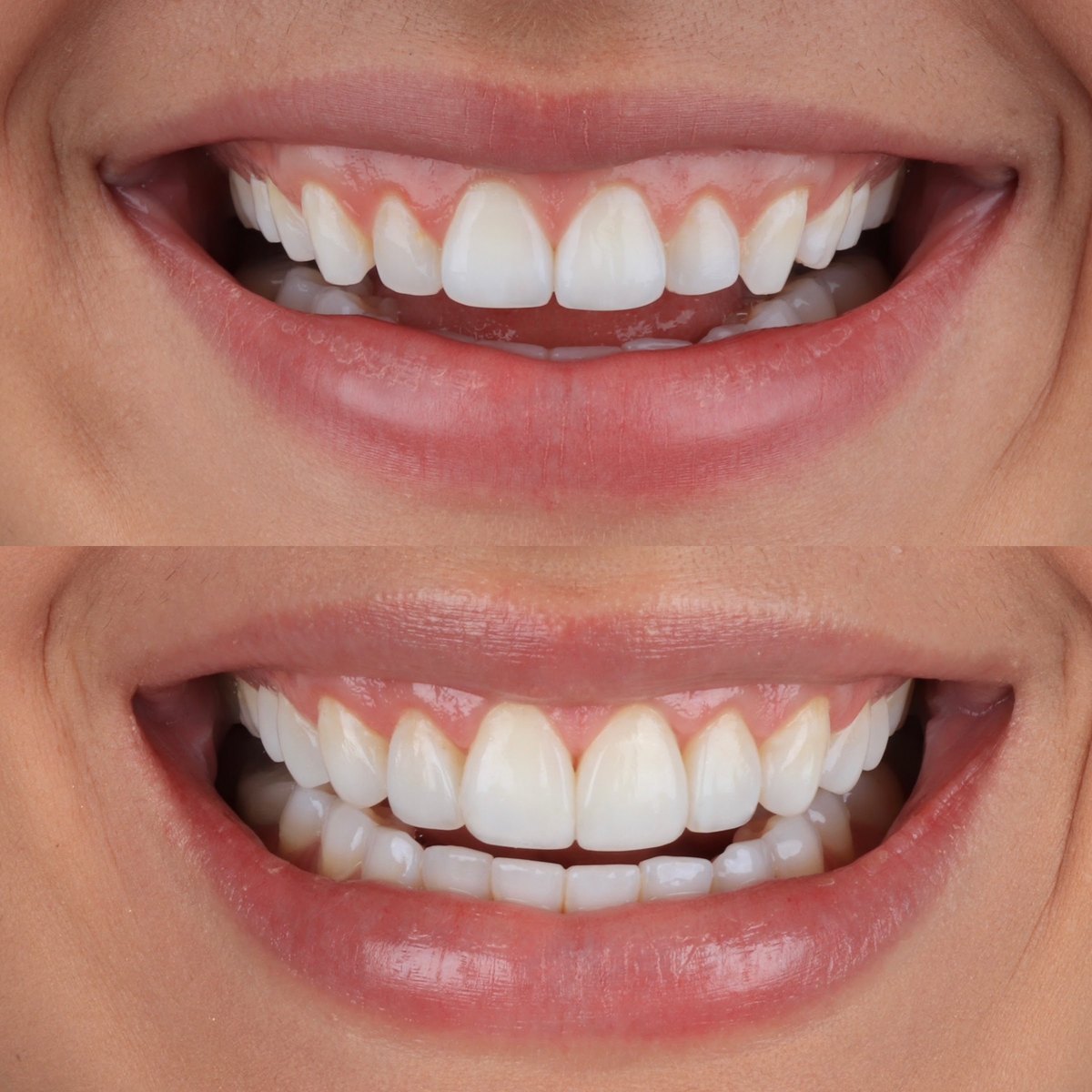 Antes e depois de resinas em dentes desgastados pelo bruxismo