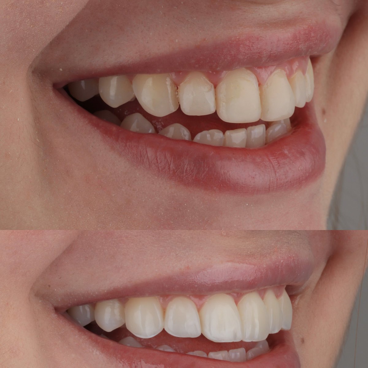Antes e depois de recontornos em resina composta