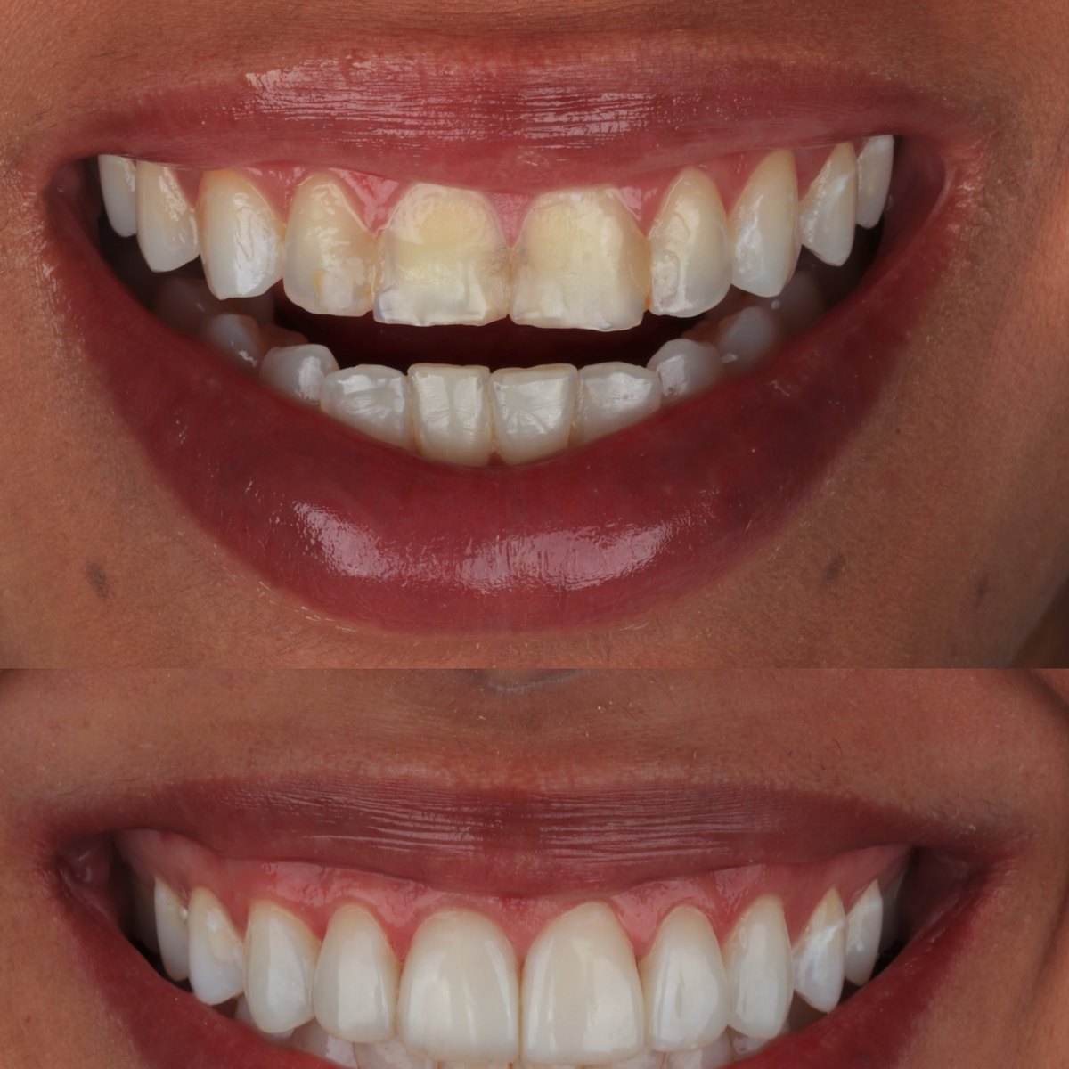 Antes e depois de um tratamento completo que levou 365 dias