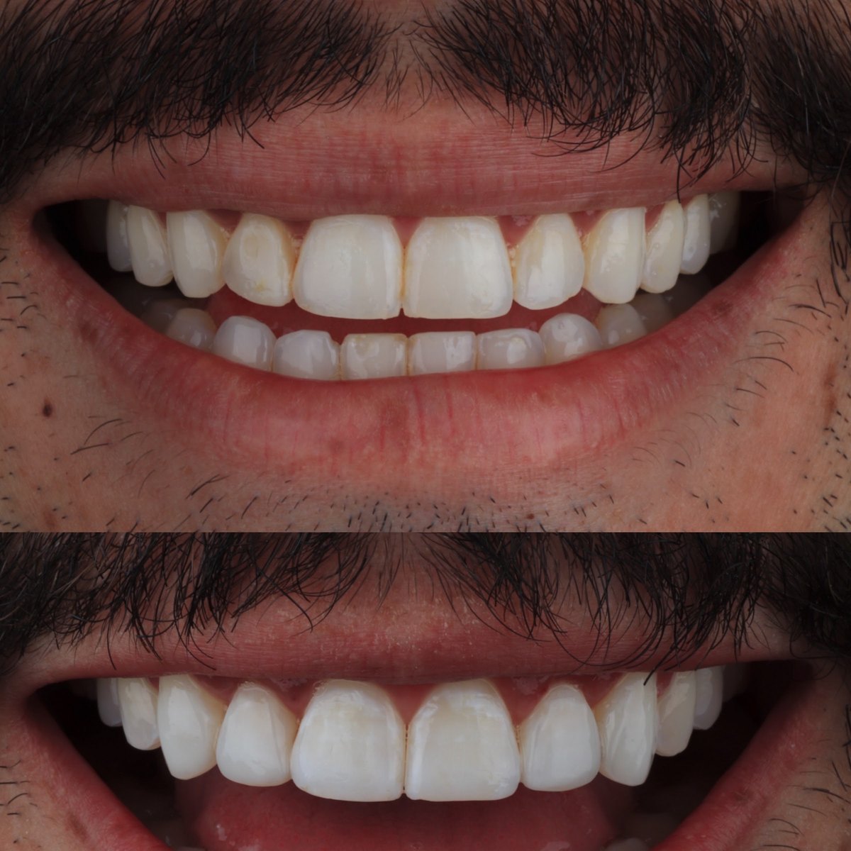 Antes e depois de reabilitação estética em paciente homem