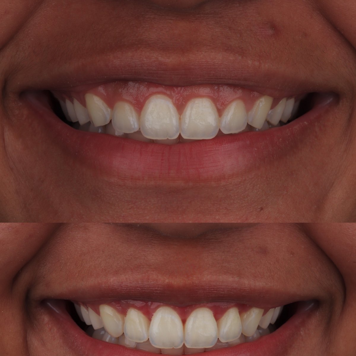 Antes e depois de remoção de lentes infiltradas e reanatomização